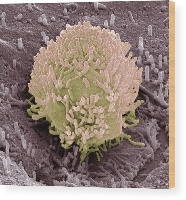 Cancer Wood Print featuring the photograph Colorectal Cancer Cell #1 by Steve Gschmeissner