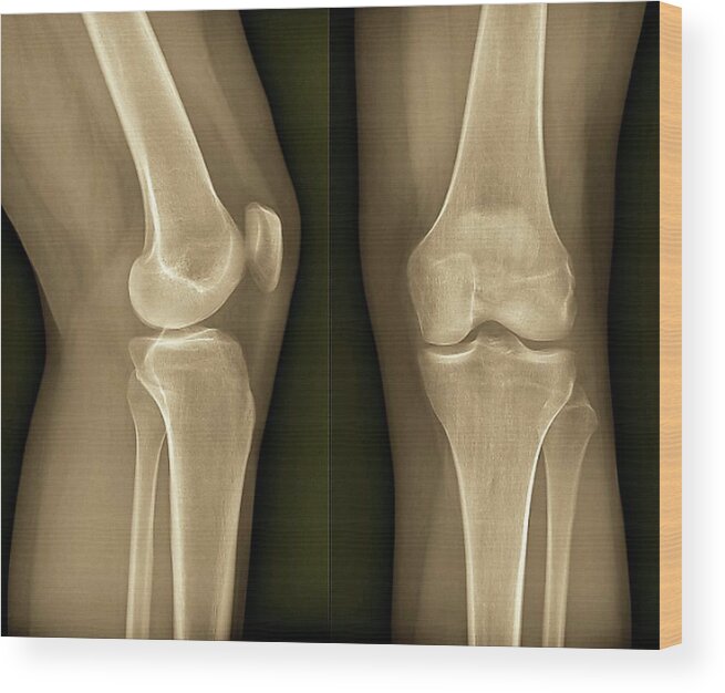 Radiography Wood Print featuring the photograph Healthy Knee #1 by Zephyr/science Photo Library
