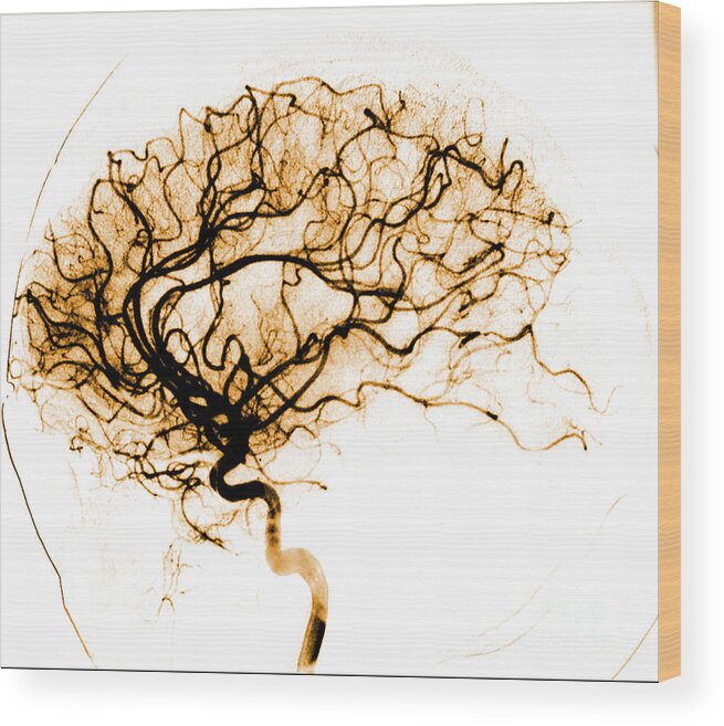 Catheter Cerebral Angiogram Wood Print featuring the photograph Cerebral Angiogram #4 by Medical Body Scans