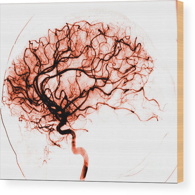 Catheter Cerebral Angiogram Wood Print featuring the photograph Cerebral Angiogram by Medical Body Scans