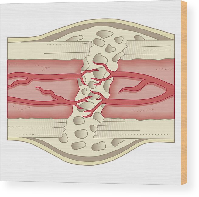 Cross Section Biomedical Illustration Of Bone Repairing Itself With New Soft Spongy Callus Developing On Framework Provided By Fibrous Tissue Joining The Broken Ends Wood Print By Dorling Kindersley