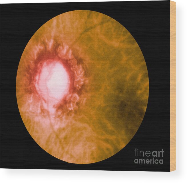 Bacteria Wood Print featuring the photograph Retina Infected By Syphilis by Science Source