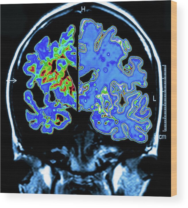 Alzheimer's Disease Wood Print featuring the photograph Alzheimer's Brain #3 by Pasieka
