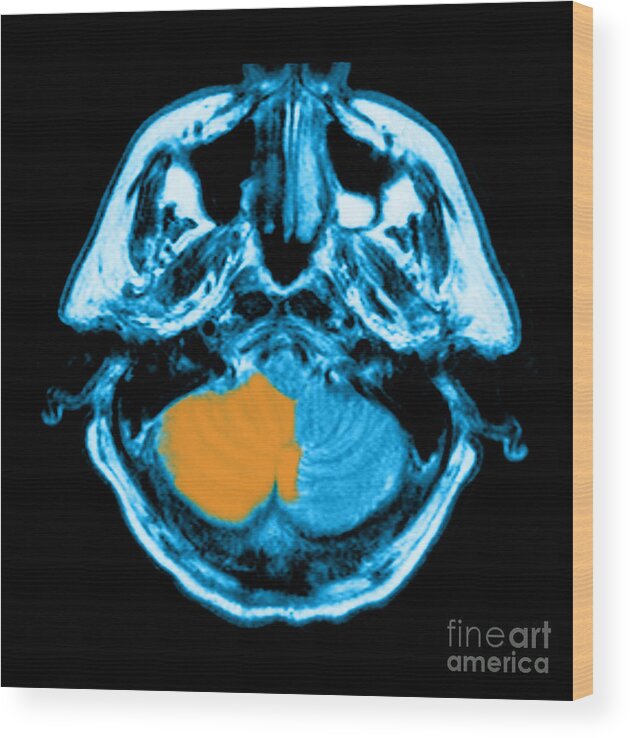 Abnormal Pica Wood Print featuring the photograph Mri Of Stroke #5 by Medical Body Scans