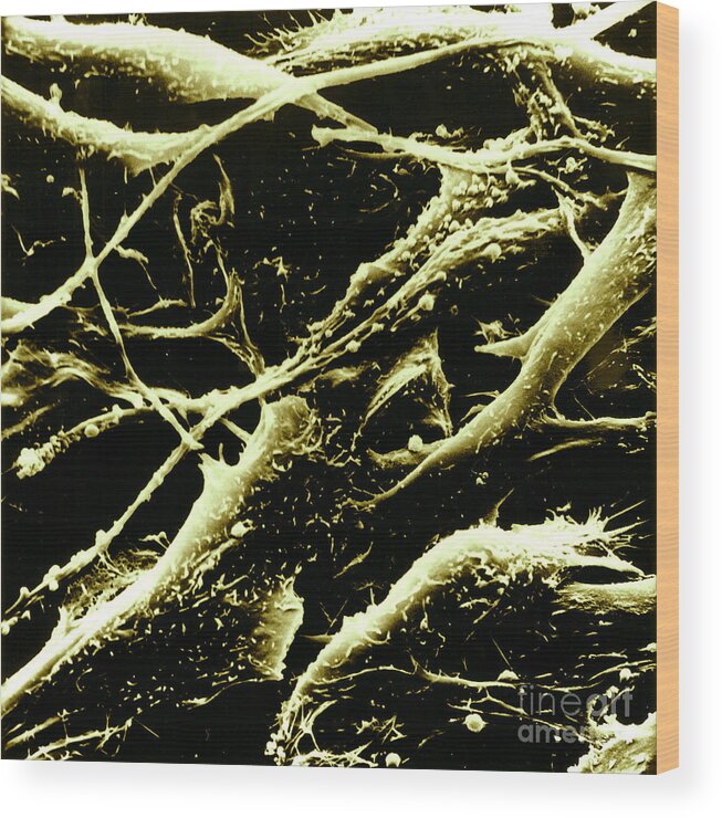Sem Wood Print featuring the photograph Melanoma by Science Source