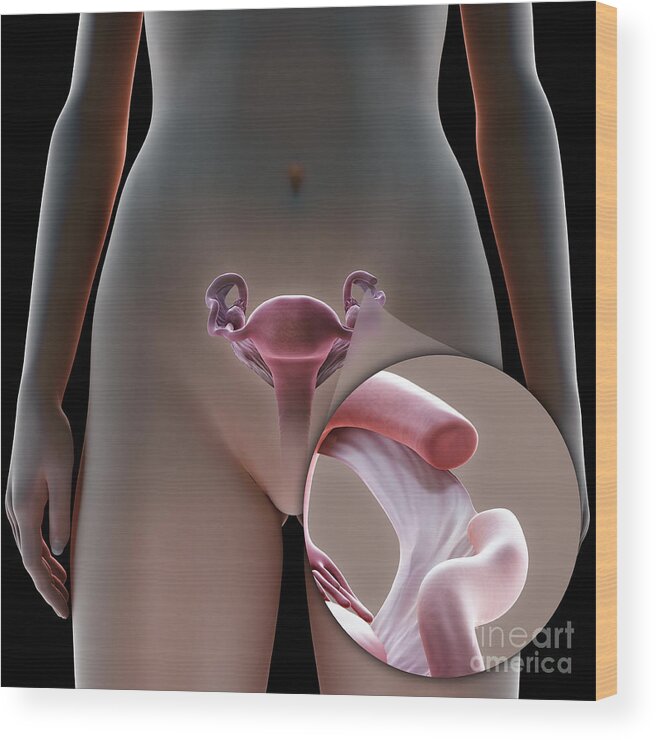 Digitally Generated Image Wood Print featuring the photograph Tubal Ligation Coagulation by Science Picture Co