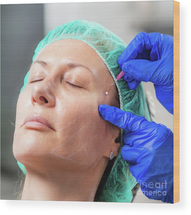 Mesotherapy Wood Print featuring the photograph Mesotherapy Thread Face Lift Procedure #3 by Microgen Images/science Photo Library