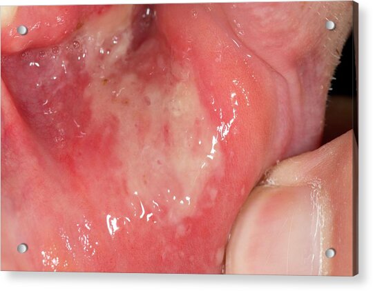Extensive Mouth Ulcer Photograph by Dr P. Marazzi/science Photo Library