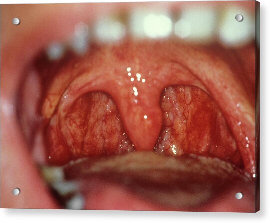 Anatomy Of Throat Tonsils