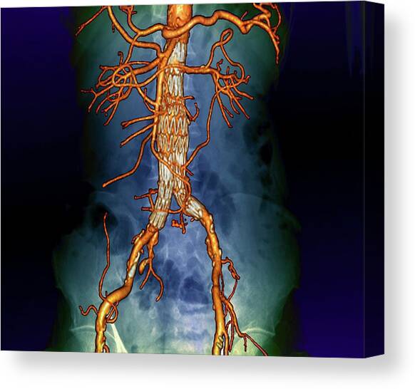Stent In The Abdominal Aorta Canvas Art Print by Science Photo Library