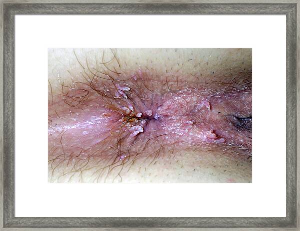 Pictures of anus warts
