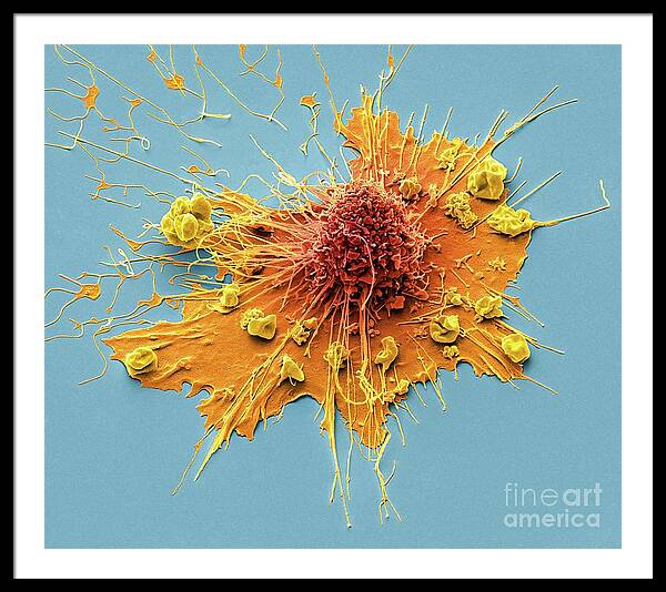 Illustration Of Phimosis: Tightness Of Foreskin Metal Print by Andrew  Bezear, Reed Business Publishing, Science Photo Library - Fine Art America