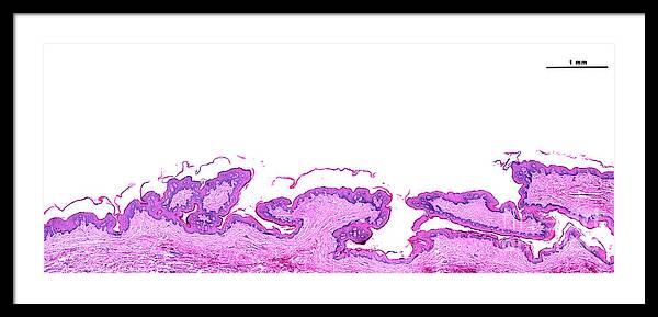 Illustration Of Phimosis: Tightness Of Foreskin Metal Print by Andrew  Bezear, Reed Business Publishing, Science Photo Library - Fine Art America