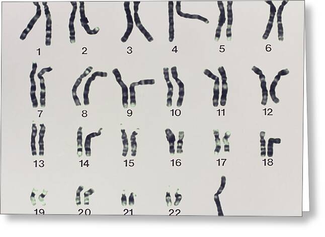 Karyotype Of Turners Syndrome Photograph By Dept Of Clinical