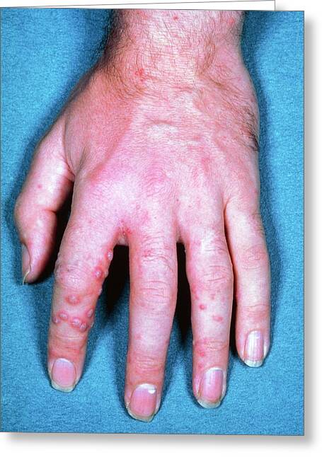Shingles Rash On Hand Photograph by James Stevenson/science Photo Library
