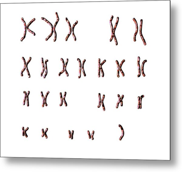 Turners Syndrome Karyotype Photograph By Kateryna Kon Science Photo