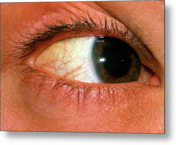 Yellowing Of Sclera Of Eye Due To Jaundice Photograph By Science Photo