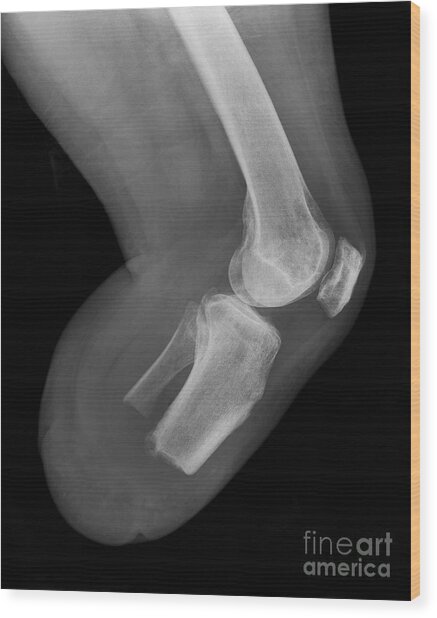 Amputated Lower Leg, X-ray Photograph by Science Photo Library