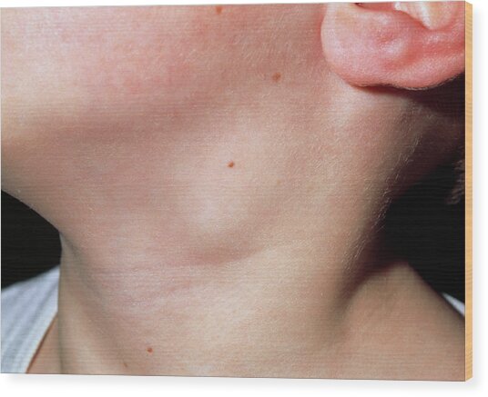 Close Up Of Swollen Lymph Node In The Neck Of Boy Photograph By Dr P