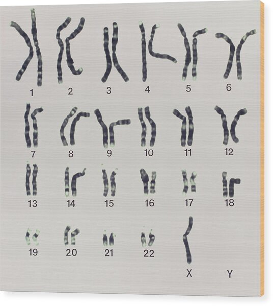 Karyotype Of Turners Syndrome Photograph By Dept Of Clinical