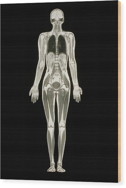 Mri Scan Of A Whole Human Body (female) Photograph by Simon Fraser/science Photo Library