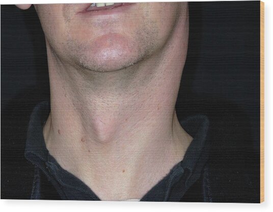 Swollen Lymph Nodes In Tonsillitis Photograph By Dr P Marazziscience