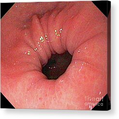 Endoscopy Acrylic Prints