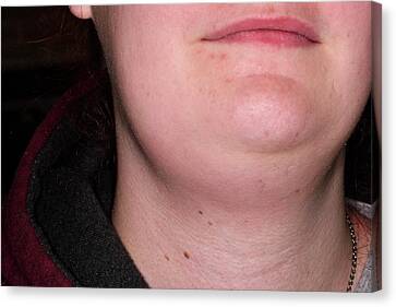 swollen neck lymph nodes