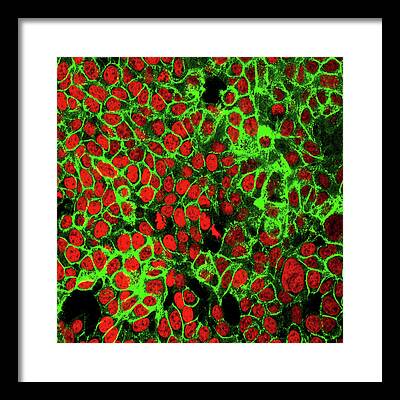 Colon Cancer Framed Prints