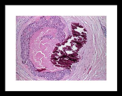 Intraductal Breast Cancer Framed Prints
