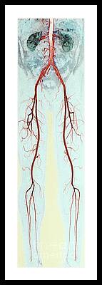 Popliteal Artery Framed Prints
