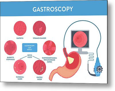 Gastroscopy Metal Prints