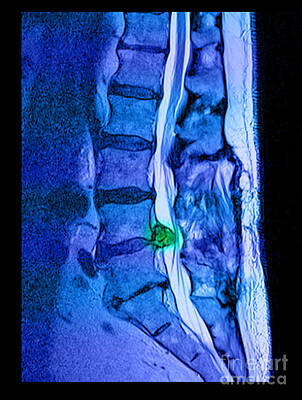 Large Herniated Disc Posters