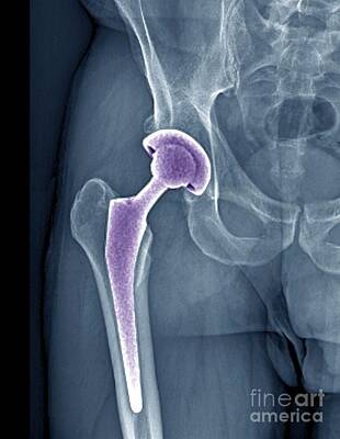Designs Similar to Total Hip Replacement #4
