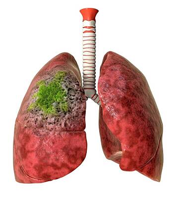Designs Similar to Lung Cancer #2