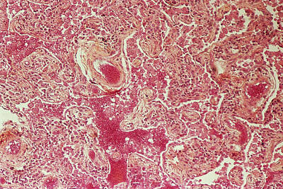 Designs Similar to Fibrosis In The Lung #1