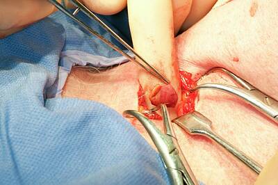 Designs Similar to Parathyroid Tumour Surgery #4