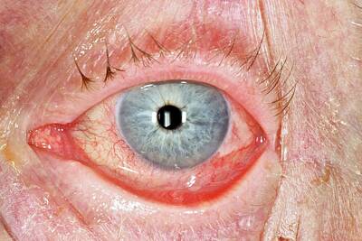 Designs Similar to Corneal Abrasion #7