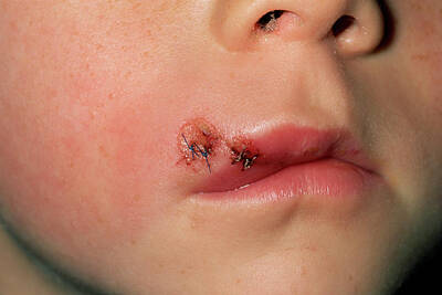 Designs Similar to Lacerated Lip