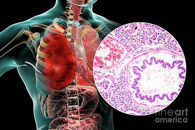 Designs Similar to Lobar Pneumonia #8