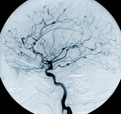 Designs Similar to Cerebral Aneurysms In Lupus