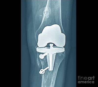 Total Knee Replacement Photos