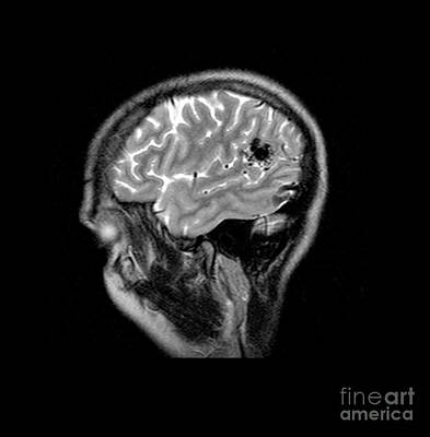 Designs Similar to Mri Of Brain Avm #2