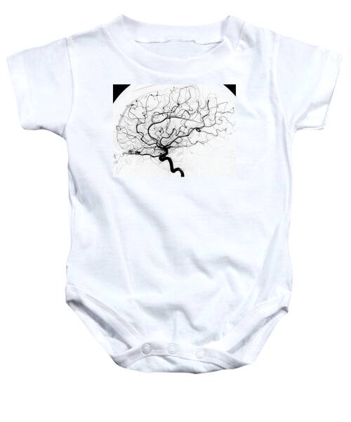 Cerebral Angiogram Baby Onesies