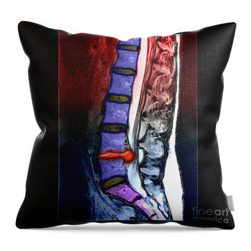 Severe Spinal Stenosis #3 Throw Pillow by Medical Body Scans - Fine Art  America