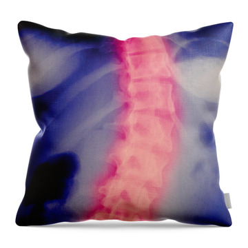 Type of scoliosis of spine - Spine - Pillow