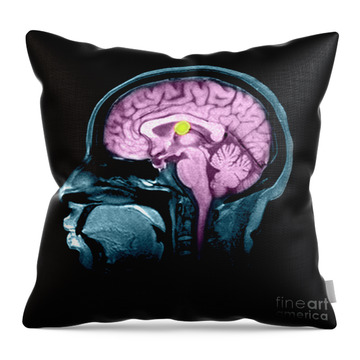 Medical Ilustration Of A Pilonidal Cyst Throw Pillow by Stocktrek Images -  Fine Art America
