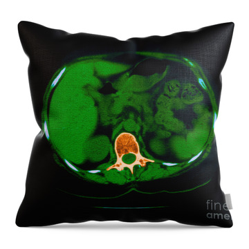https://render.fineartamerica.com/images/rendered/search/throw-pillow/images-medium/1-scoliosis-granuloma--calcification-science-source.jpg