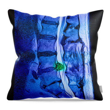 Medical chart showing the signs and symptoms of sciatica. Throw Pillow for  Sale by StocktrekImages