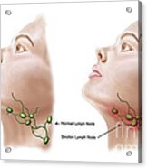 Anatomy Of Swollen Lymph Nodes #1 Acrylic Print